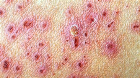 are the other rashes with symptoms similar to shingles
